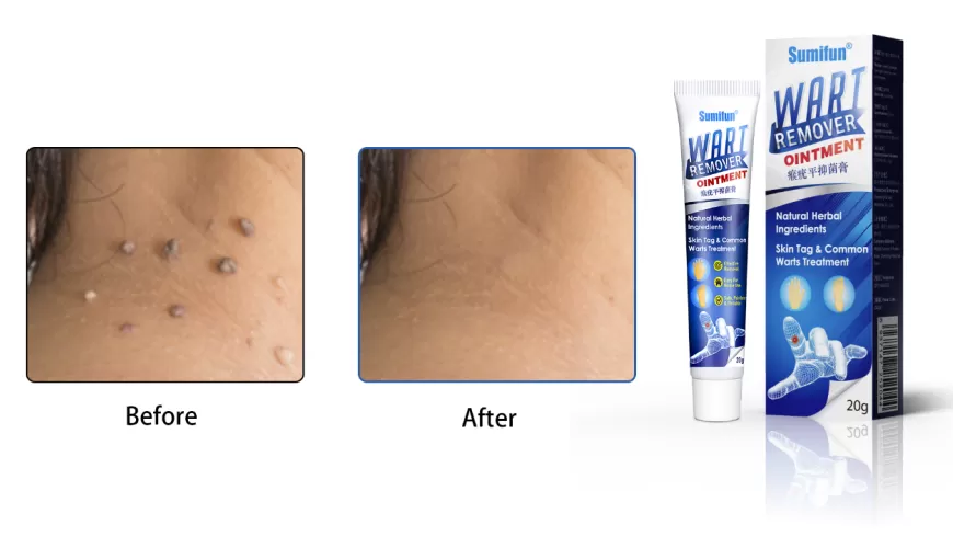 How To Use Sumifun Wart Remover: A Comprehensive Guide How To Use Sumifun Wart Remover: A Comprehensive Guide